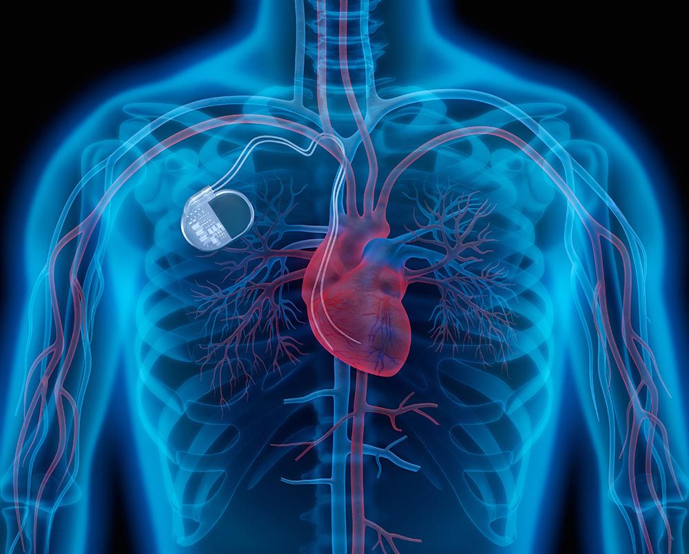 Medical illustration of chest, ribcage and heart featuring BaroPace technology