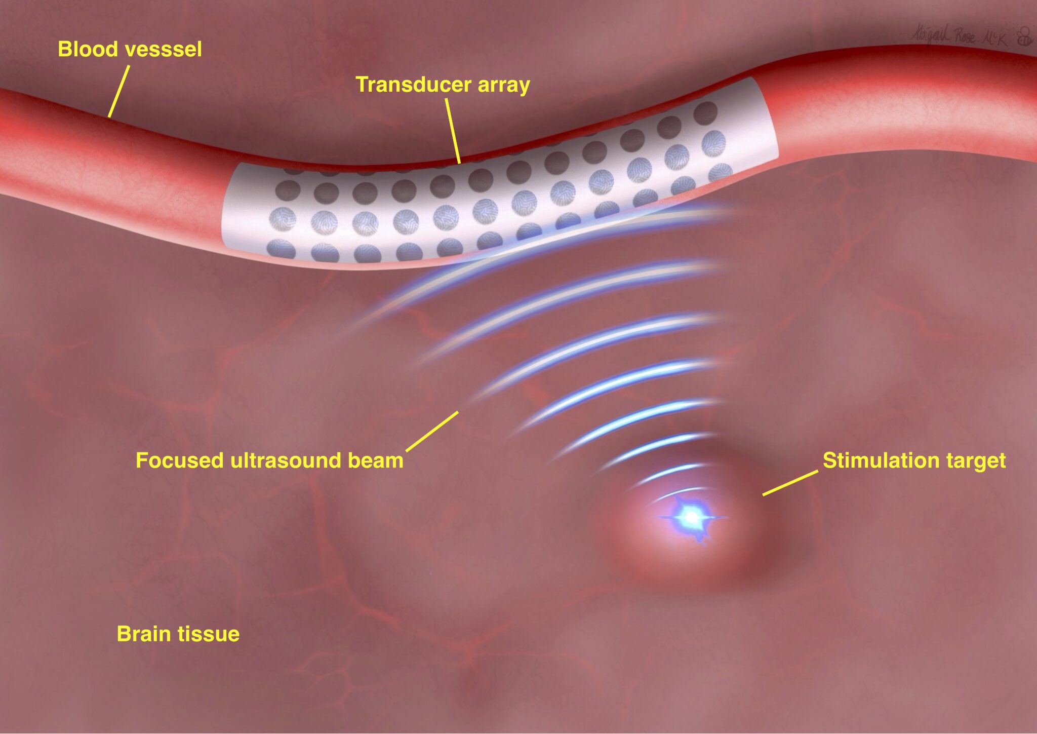 Annotated illustration of brain tissue and proposed project technology.